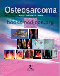 Image of Osteosarcoma